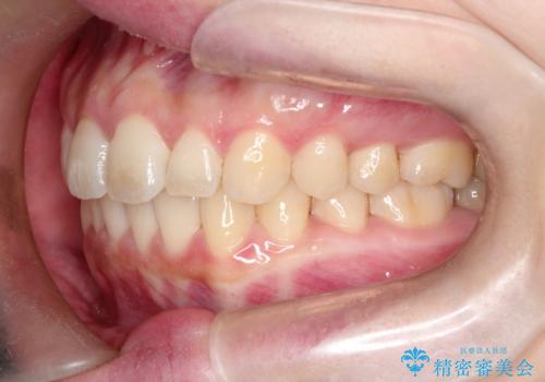 【インビザライン】前歯が出てるのを治したいの治療後