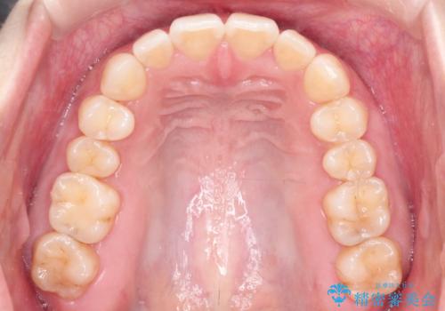 【インビザライン】前歯が出てるのを治したいの治療後