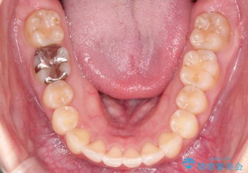 【インビザライン】前歯が出てるのを治したいの治療後