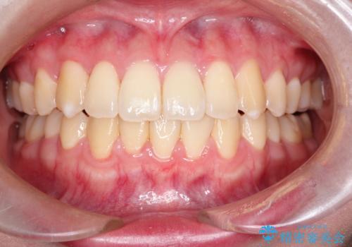 【インビザライン】歯を抜かずにできるだけ前歯を下げたい