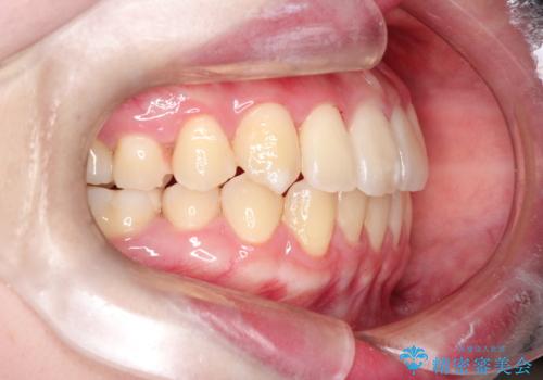 【インビザライン】歯を抜かずにできるだけ前歯を下げたいの治療後