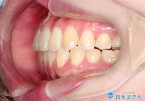 【インビザライン】歯を抜かずにできるだけ前歯を下げたいの治療後