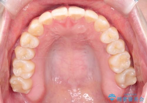 【インビザライン】歯を抜かずにできるだけ前歯を下げたいの治療後