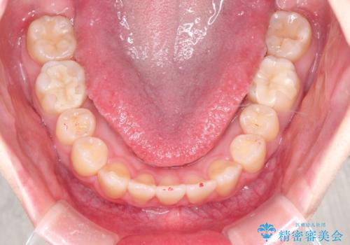 【インビザライン】歯を抜かずにできるだけ前歯を下げたいの治療後