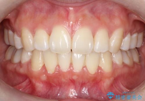 【審美ワイヤー】抜歯矯正の治療後