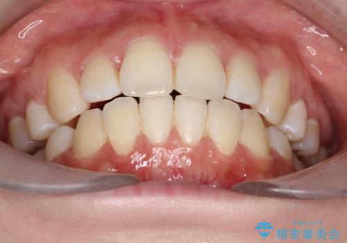 【審美ワイヤー】抜歯矯正の治療後