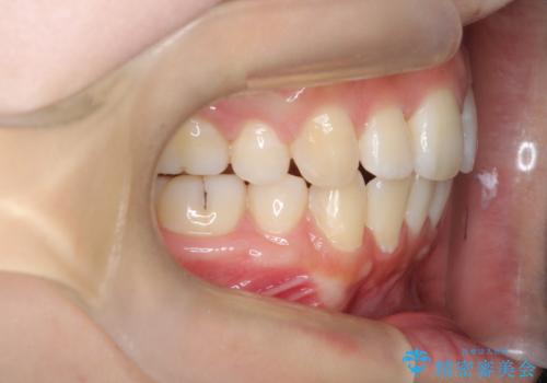 【審美ワイヤー】抜歯矯正の治療後