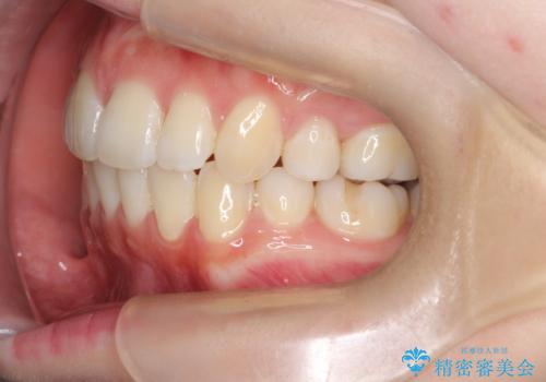 【審美ワイヤー】抜歯矯正の治療後