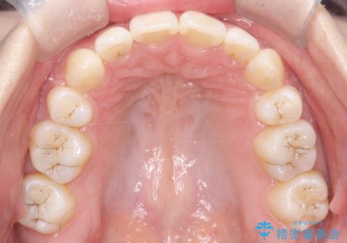 【審美ワイヤー】抜歯矯正の治療後