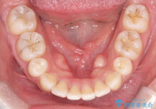 【審美ワイヤー】抜歯矯正の治療後