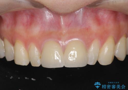 [ 前歯部セラミック治療 ]目立つ前歯をきれいにしたいの症例 治療後