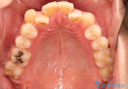 【八重歯・がたつきでお悩みの方必見】抜歯矯正症例(審美ワイヤー矯正)の治療前