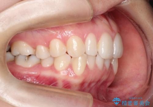 【前歯のがたつきでお悩みの方必見】インビザライン矯正の症例の治療前