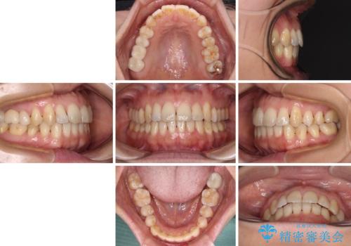 後戻りの再矯正治療と欠損部の補綴治療の治療後