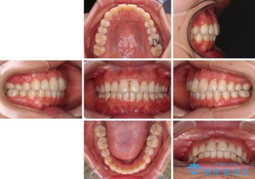 前歯の捻れを改善 インビザラインによる矯正治療の治療後