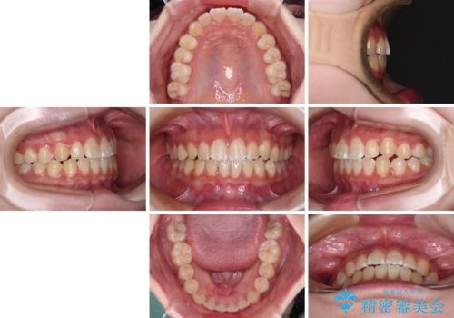 むし歯になりやすい奥歯 補助装置で一気に解決の治療後