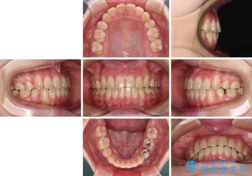 上下の出っ歯を治したい ワイヤー装置による抜歯矯正の治療後
