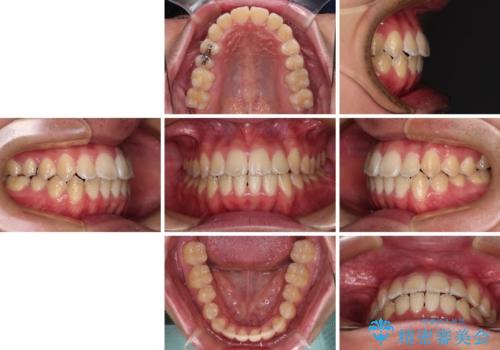 非抜歯ワイヤー装置による、短期間での矯正治療の治療後