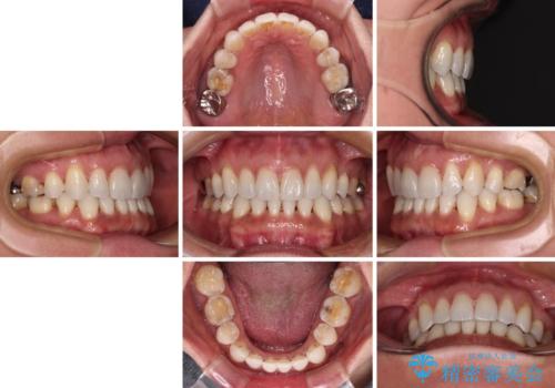 抜歯矯正の後戻りをインビザライン・ライトで解消の治療後