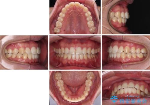 インビザラインで奥歯の咬み合わせと前歯のデコボコを改善の治療後