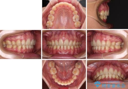 上顎前突 目立たないワイヤー装置での抜歯矯正の治療後