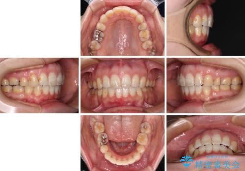 口元の突出感改善 なるべく銀歯を抜歯してワイヤー矯正の治療後
