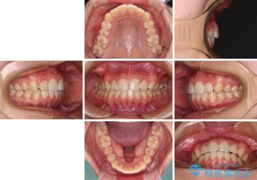 カリエール・ディスタライザーとインビザラインを用いた奥歯の咬み合わせ改善の治療後