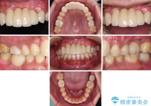 事故で抜歯となった前歯 ブリッジやインプラントによる補綴治療の治療後