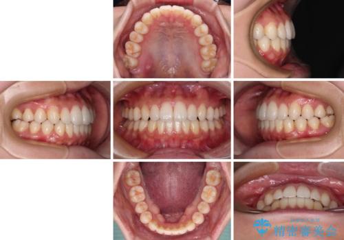 インビザラインで口を閉じやすくの治療後