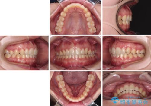 気になる残存乳歯と八重歯 ワイヤー矯正を併用したインビザライン治療の治療後