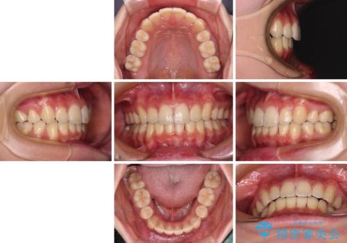 短期間で口元の突出感を改善 ワイヤー装置での抜歯矯正の治療後