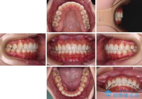 八重歯を改善 目立たないワイヤー装置での矯正治療の治療後
