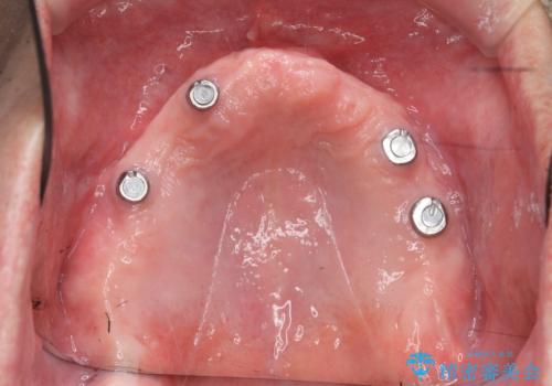 [ インプラントオーバーデンチャー ] インプラント+入れ歯・ブリッジで作るしっかりとした咬合状態の治療中