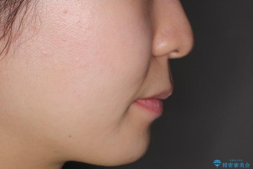 【前歯のがたつきでお悩みの方必見】インビザライン矯正の症例の治療前(顔貌)