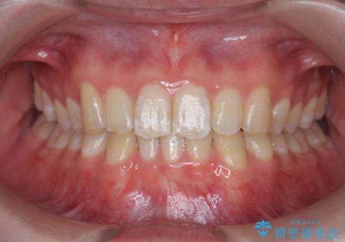 クロスバイト・歯並びが原因の歯肉退縮歯、矯正治療による審美性の改善の症例 治療後
