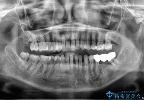 部分矯正してからオールセラミックブリッジの治療後