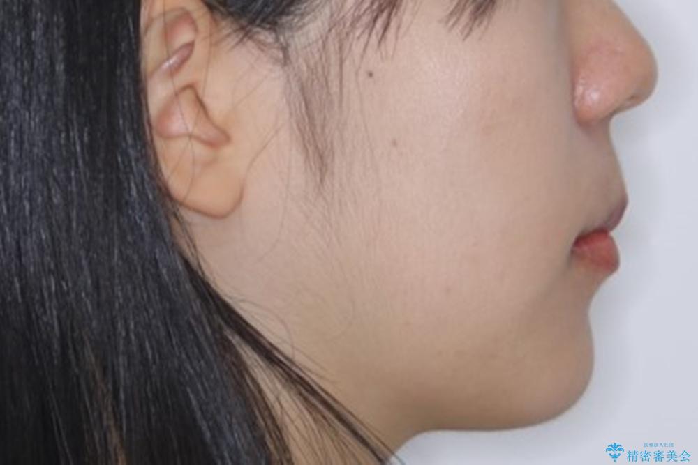 八重歯の解消とインプラントの下準備をインビザラインでの治療前(顔貌)