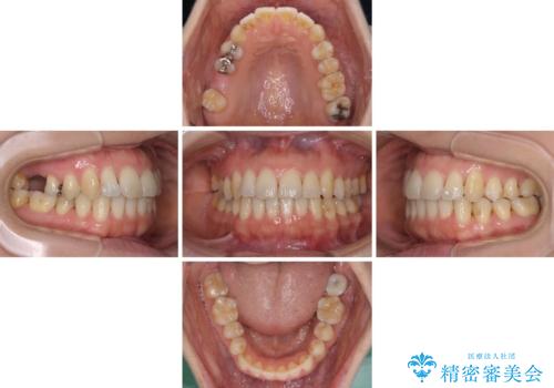 後戻りの再矯正治療と欠損部の補綴治療の治療中