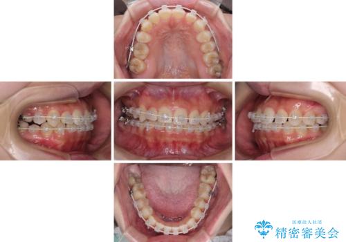 八重歯を改善　目立たないワイヤー装置での矯正治療の治療中