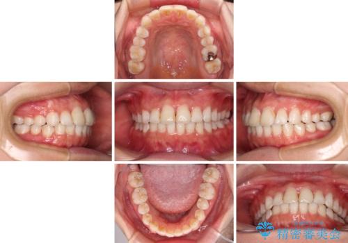 前歯の捻れを改善 インビザラインによる矯正治療の治療中