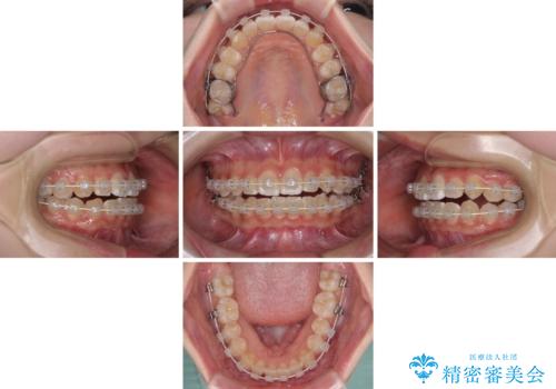 むし歯になりやすい奥歯 補助装置で一気に解決の治療中