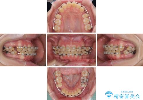上下の出っ歯を治したい ワイヤー装置による抜歯矯正の治療中