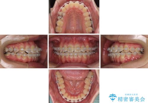 非抜歯ワイヤー装置による、短期間での矯正治療の治療中