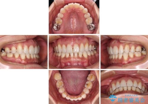 抜歯矯正の後戻りをインビザライン・ライトで解消の治療中