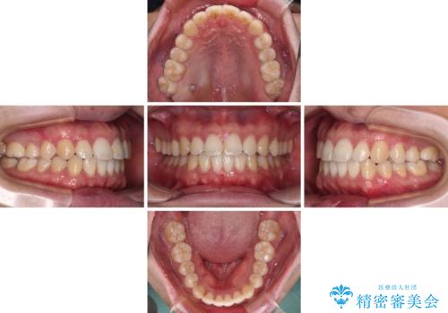 インビザラインで奥歯の咬み合わせと前歯のデコボコを改善の治療中