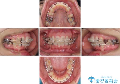 口元の突出感改善　なるべく銀歯を抜歯してワイヤー矯正の治療中