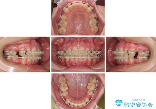 上顎前突 目立たないワイヤー装置での抜歯矯正の治療中