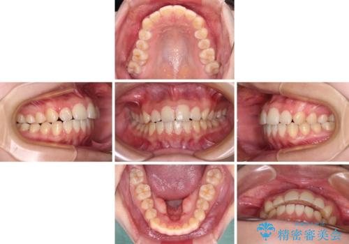 カリエール・ディスタライザーとインビザラインを用いた奥歯の咬み合わせ改善の治療中