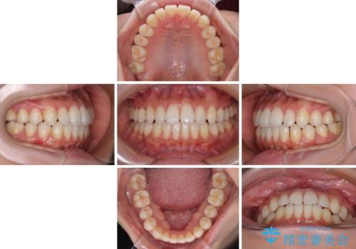 インビザラインで口を閉じやすくの治療中