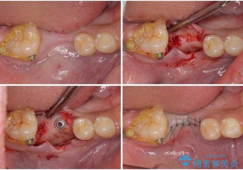 事故で抜歯となった前歯　ブリッジやインプラントによる補綴治療の治療中